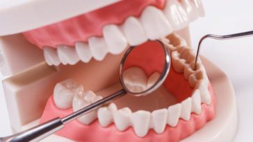 Cara Menghilangkan Karang Gigi