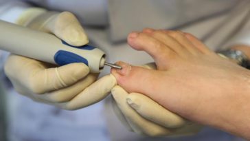 cara mengatasi kuku berjamur