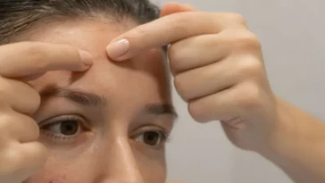 ciri jerawat di dahi