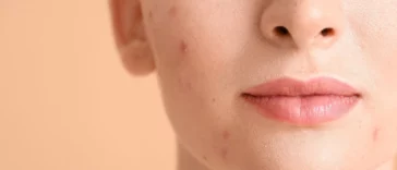 skincare untuk menghilangkan bekas jerawat