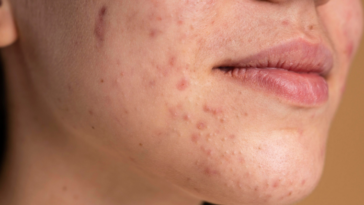 Urutan Skincare untuk Kulit Kering